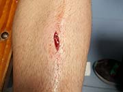 corte en la tibia